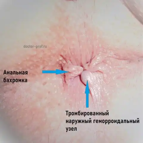 Тромбированный наружный геморроидальный узел и анальная бахромка