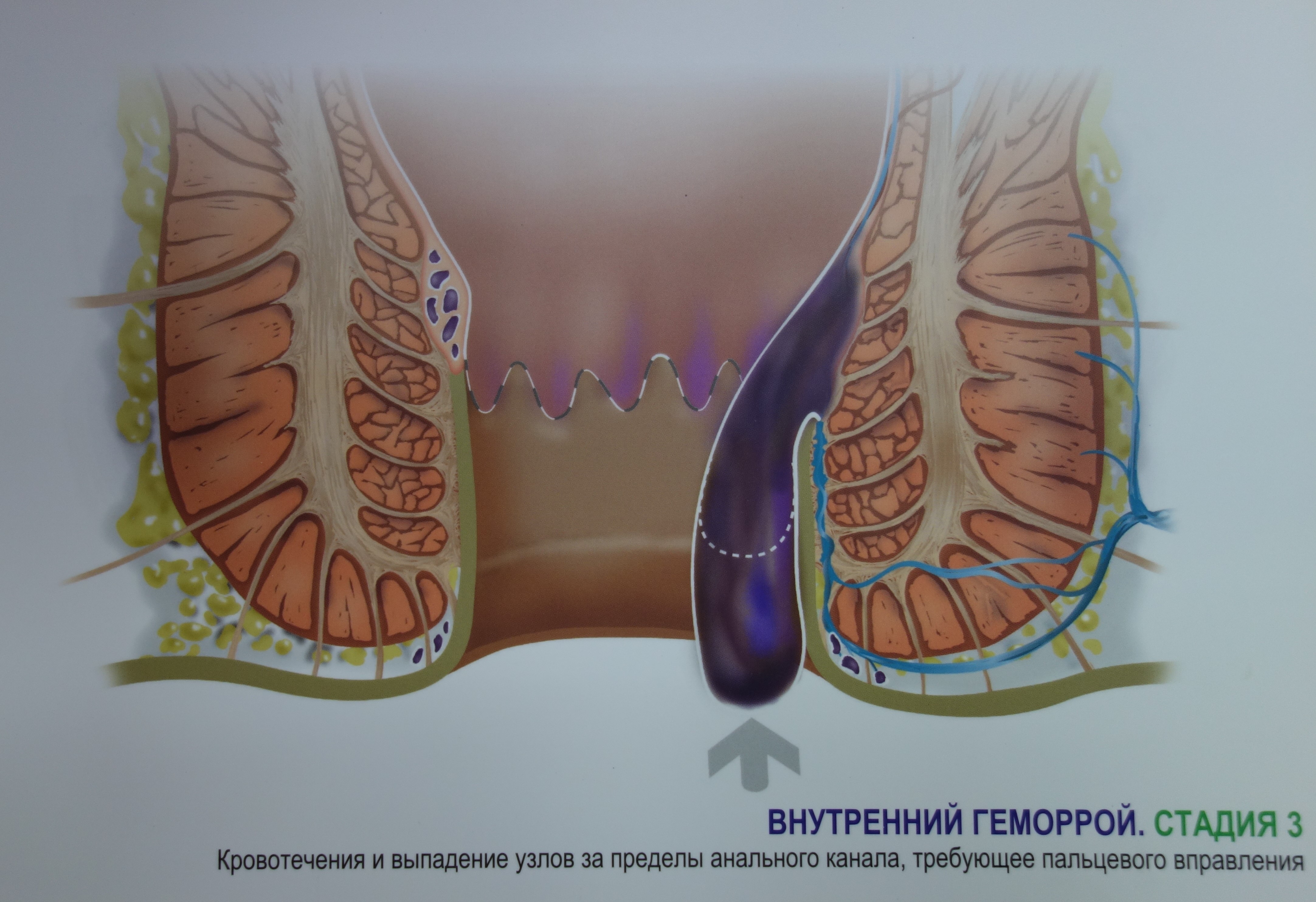 Геморрой внутренний симптомы у женщин лечение лекарства. Внутренний геморрой фото. Кал при внутреннем геморрое.