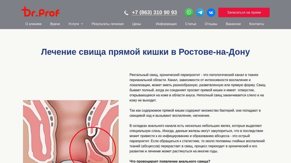 Свищи прямой кишки: причины, симптомы и лечение