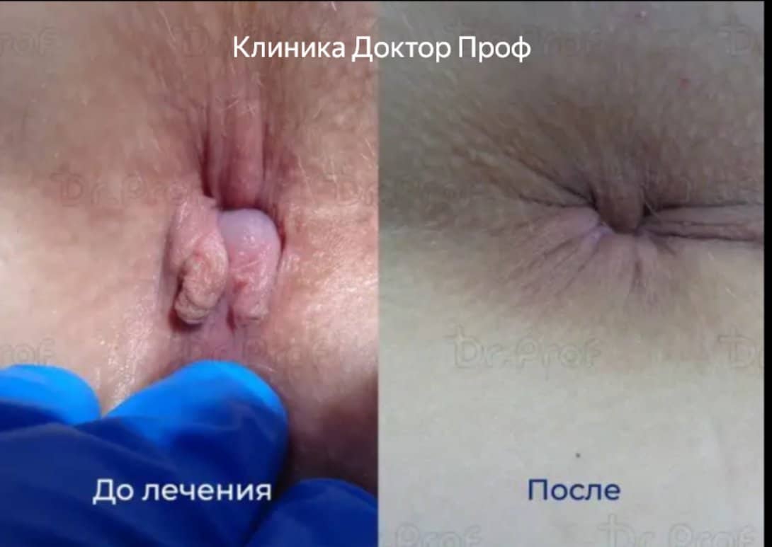 Тромбоз геморроидальных узлов до и после лечения в клинике Доктор Проф, Ростов-на-Дону